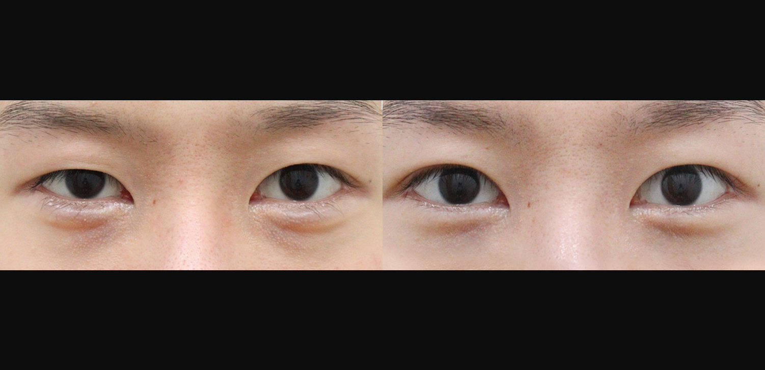 자연유착 눈매교정 재수술