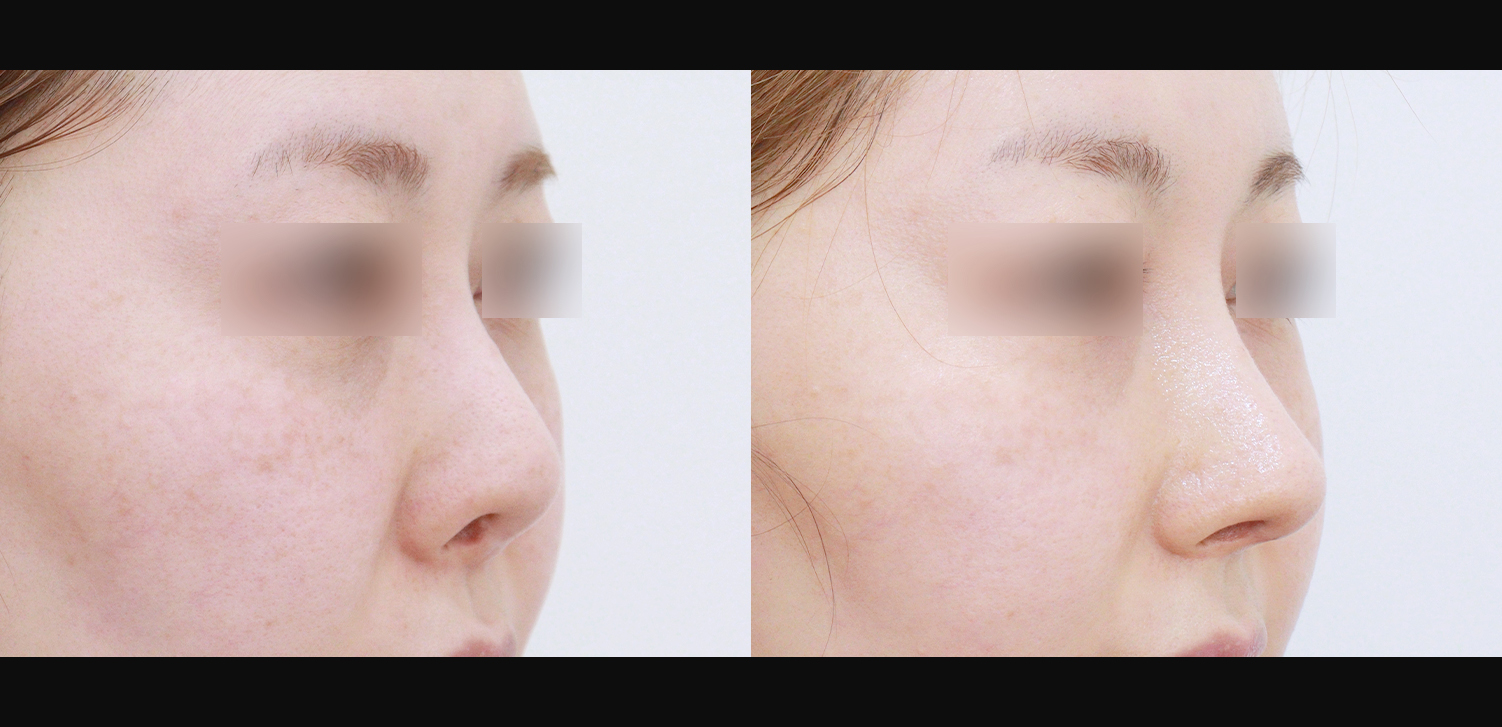 3D코성형 재수술(콧대+코끝+비중격재건+비주처짐개선)