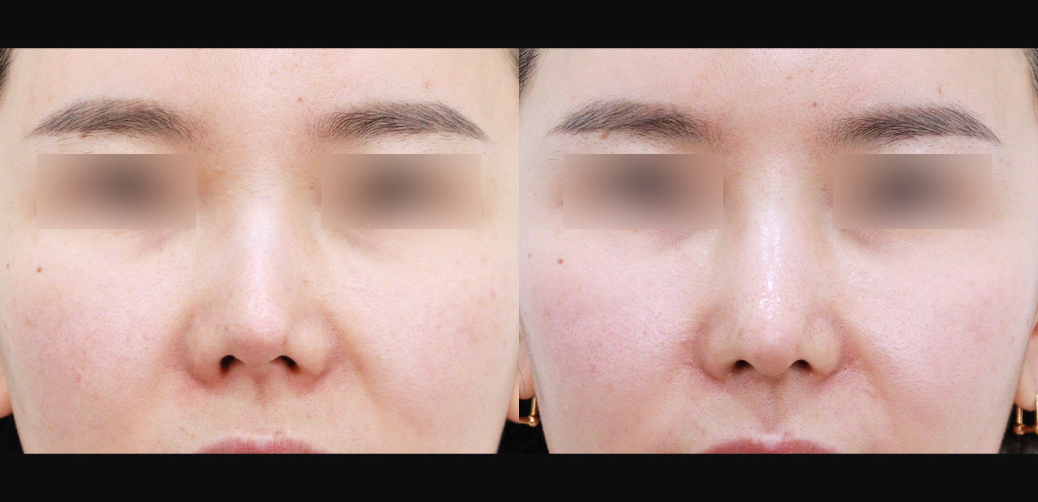 3D코성형 재수술(들창코+찝힌코+인중코)