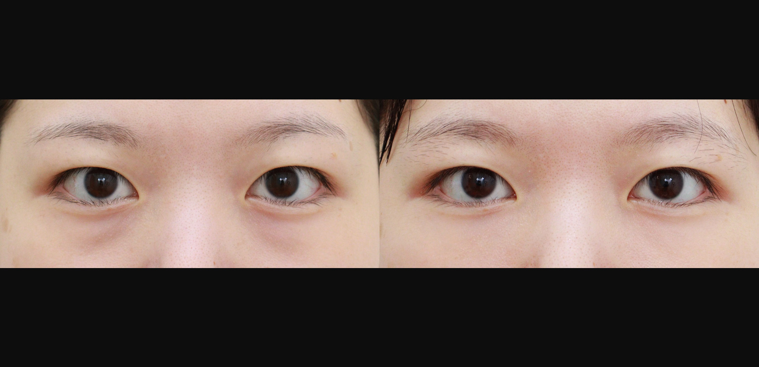 눈밑지방재배치