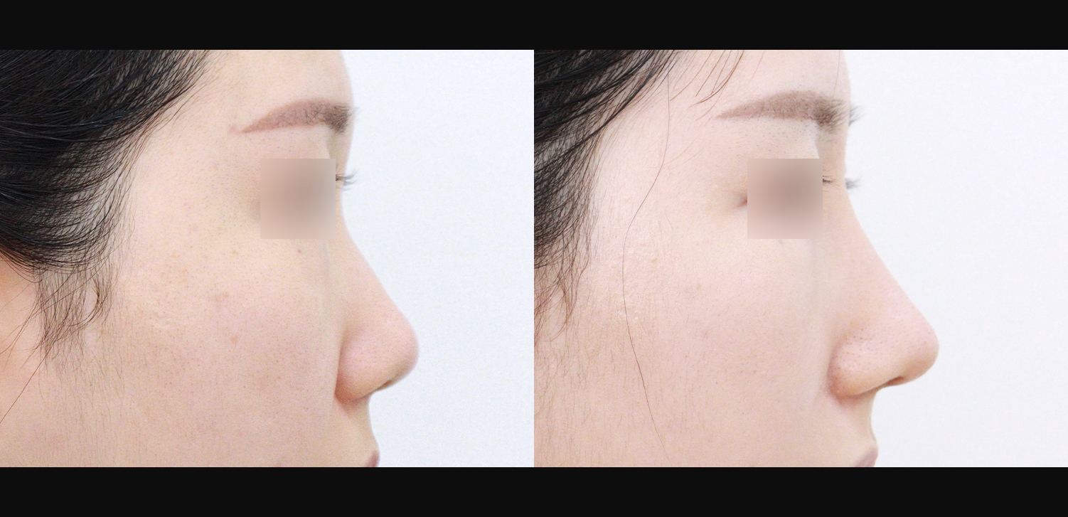 3D 코성형(콧대+코끝+들창코+인중코)