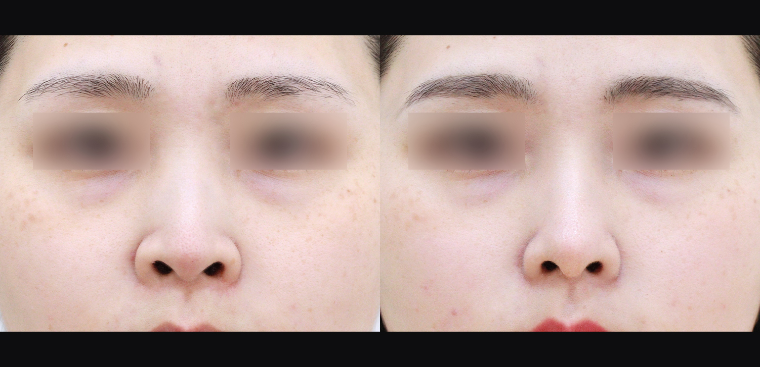 코끝+들창코+콧볼축소