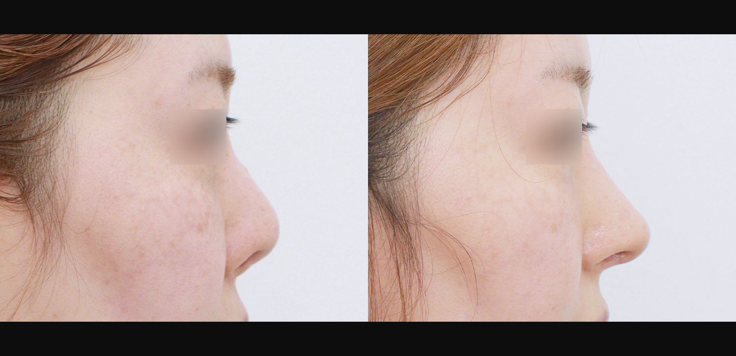 3D코성형 재수술(콧대+코끝+비중격재건+비주처짐개선)