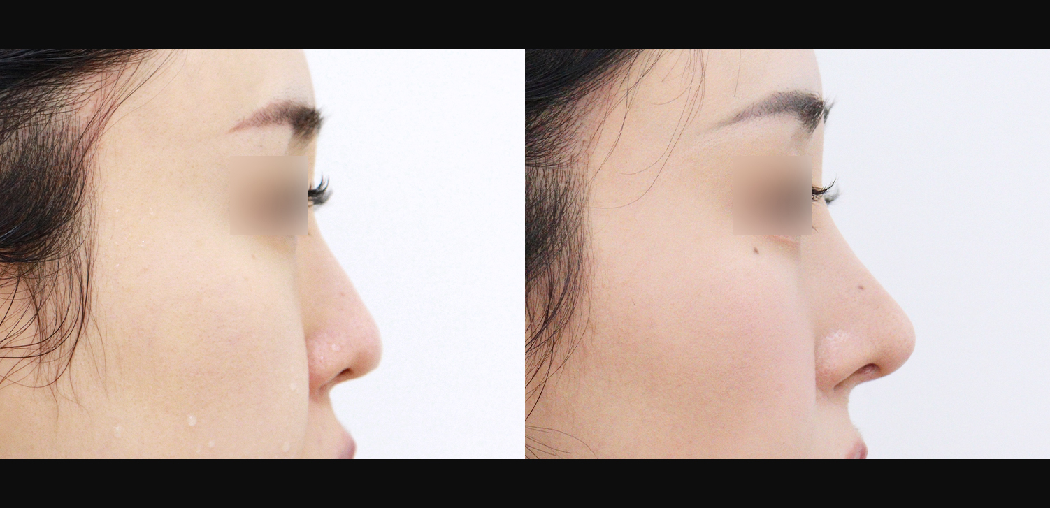 3D 코성형(콧대+코끝+인중코)