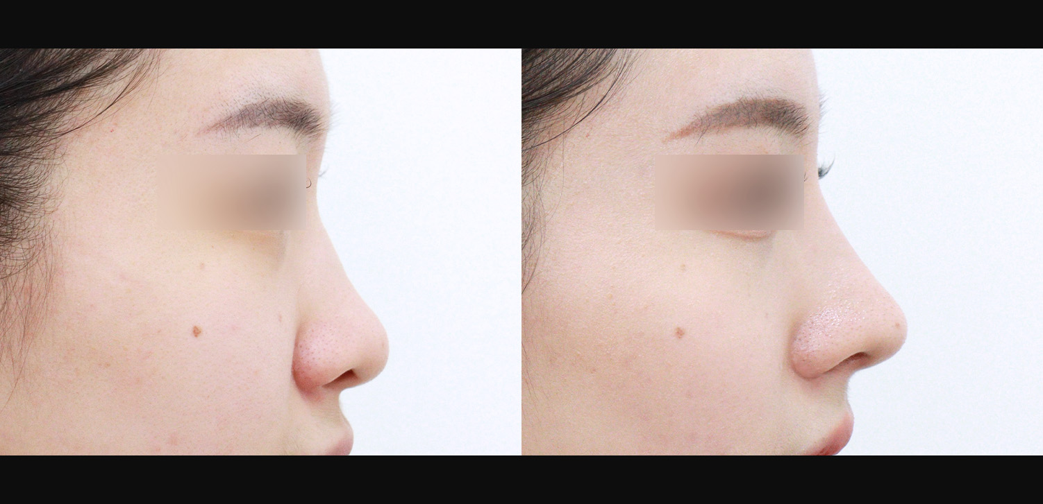 3D코성형 재수술(휜코+복코+기능코)