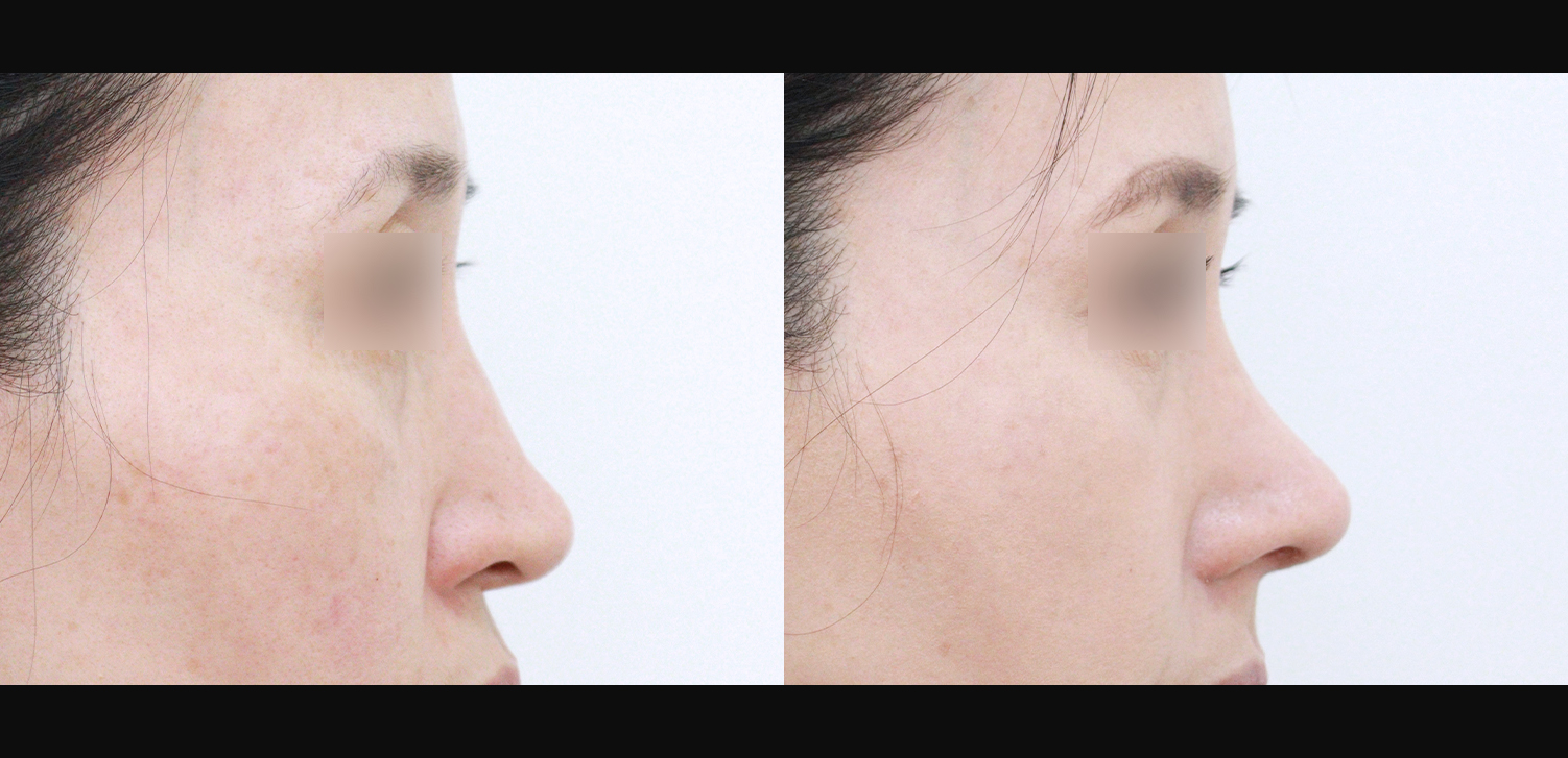 코끝+매부리+인중코+콧볼축소+기능코