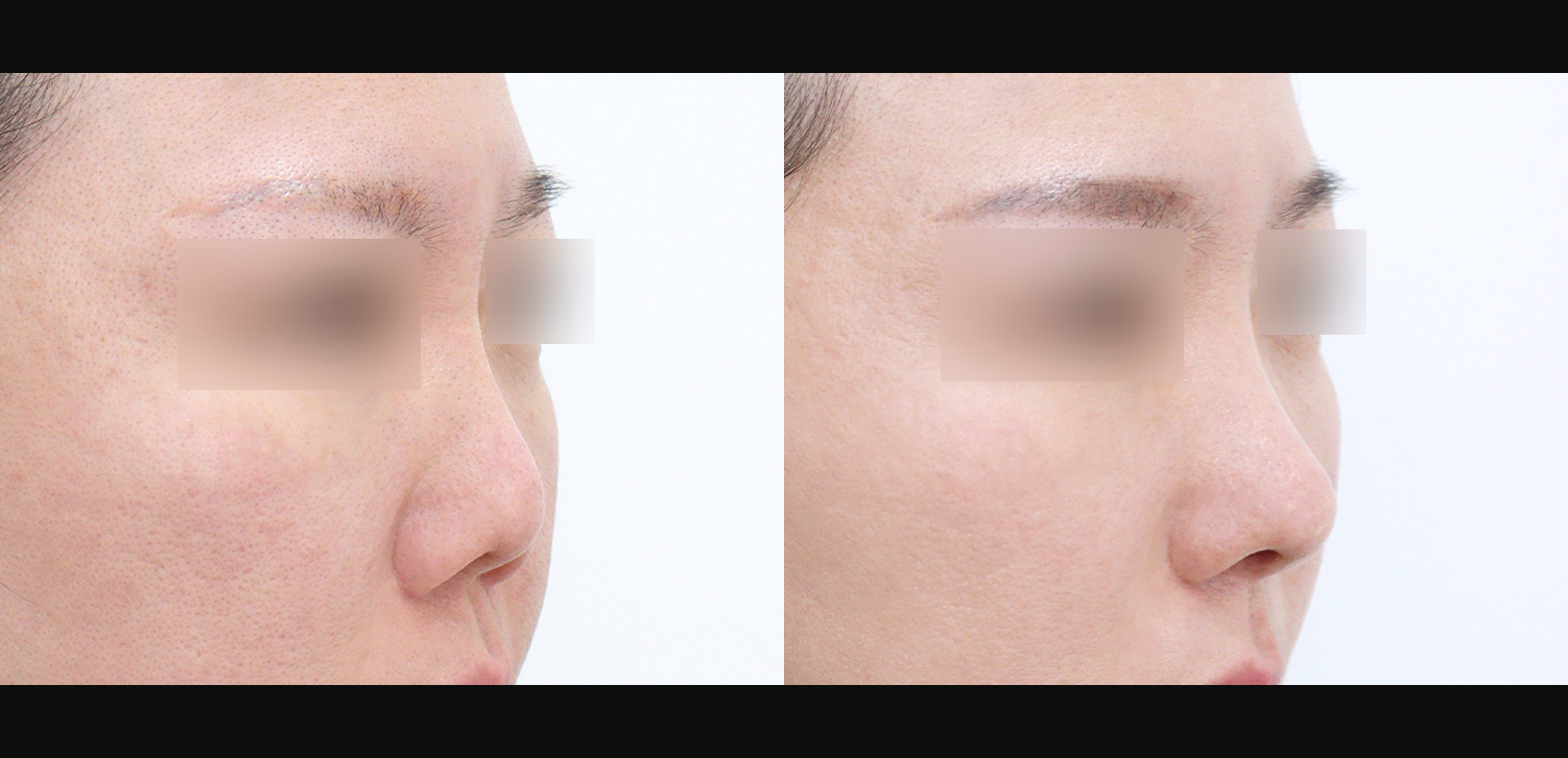 3D 코성형 재수술(자가늑+찝힌코+휜코+구축코+인중+기능코+비주빼기)