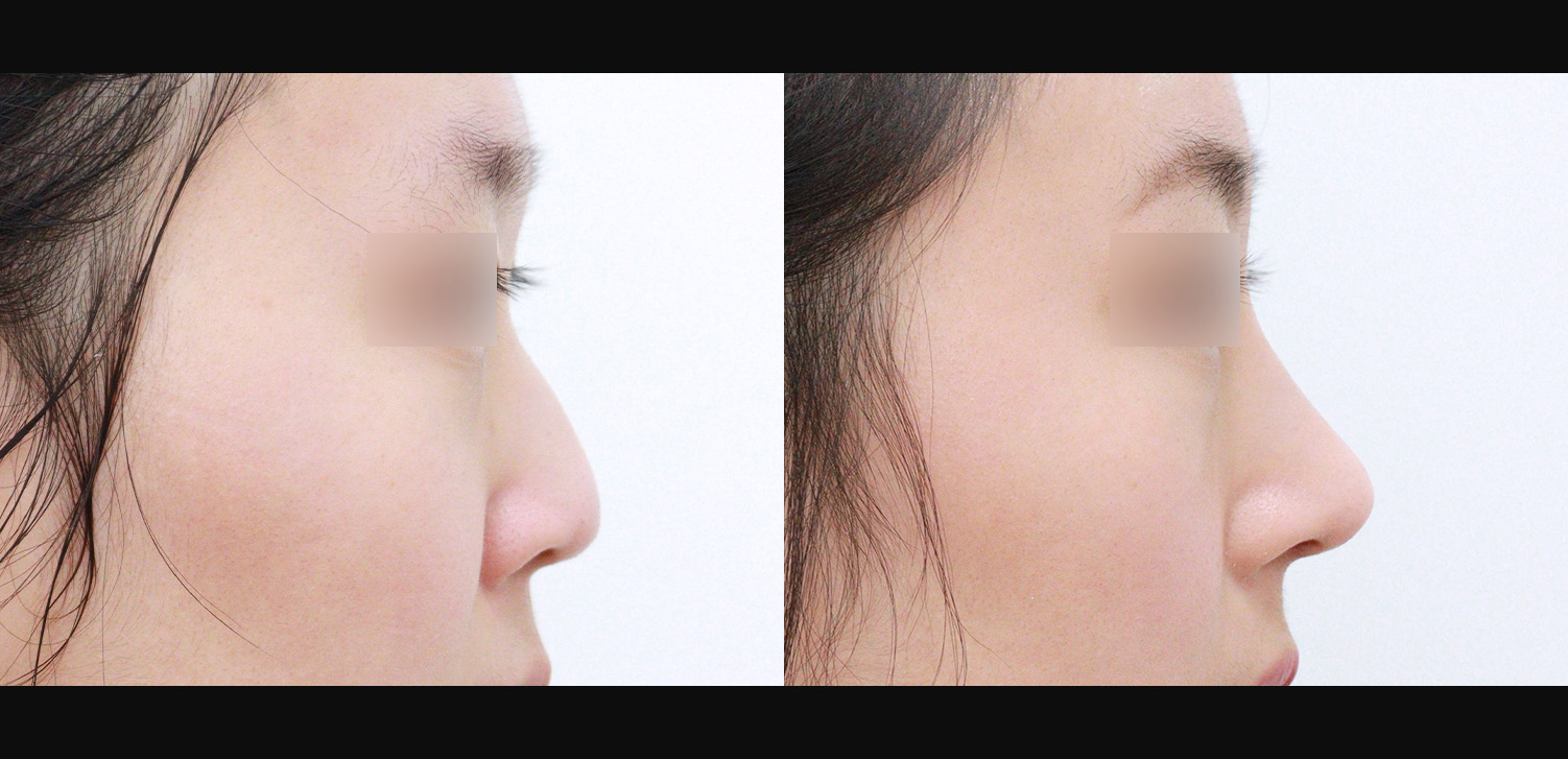 3D코성형(들창코+복코+인중코)