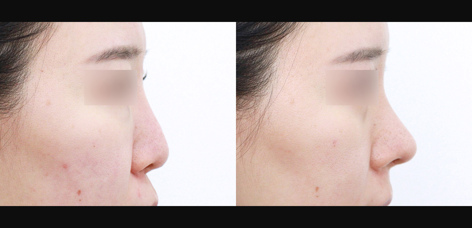 3D코성형 재수술(인중코+기능코)