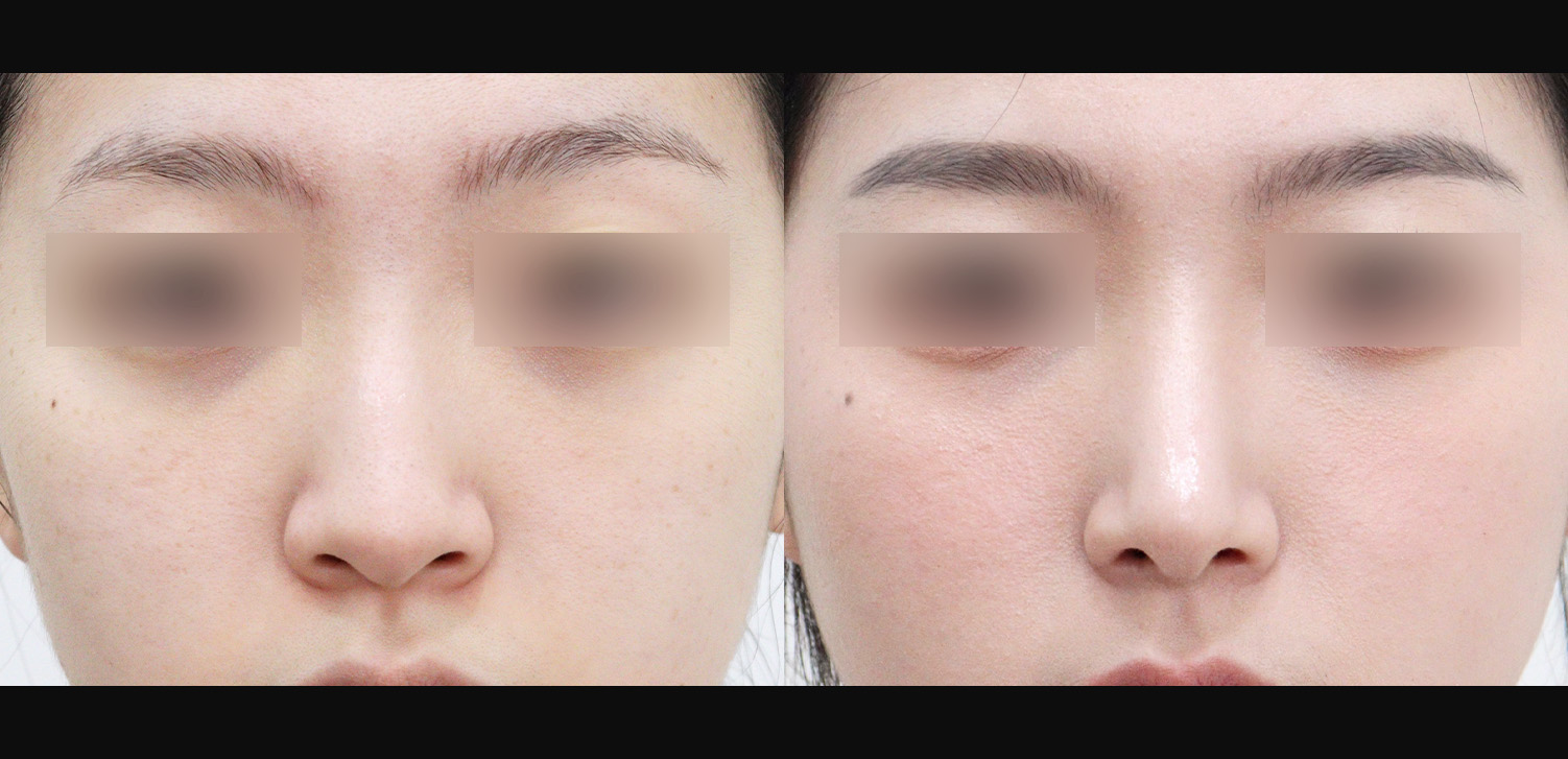 화살코+용코+휜코+인중코+콧볼축소+기능코