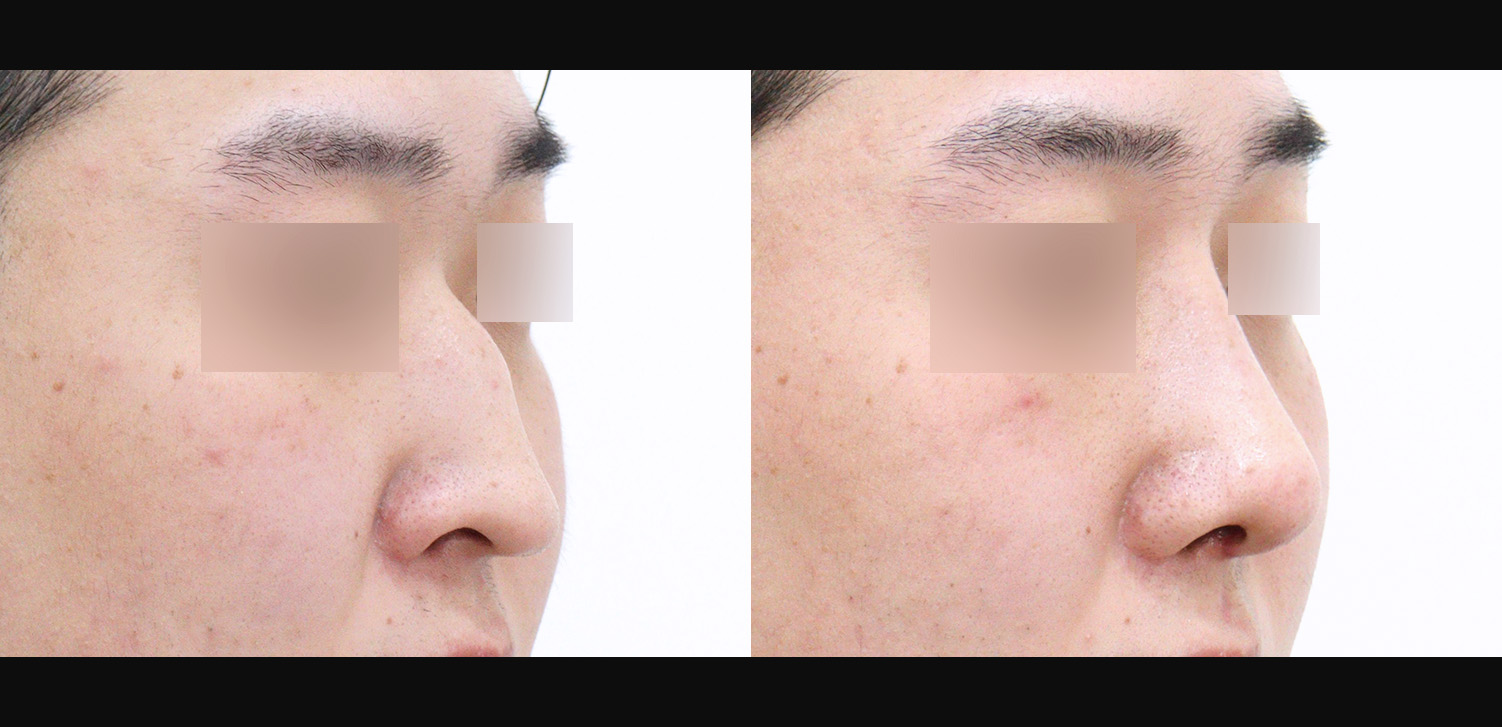 3D코성형(자가늑+콧대+코끝+매부리+화살코+용코+인중코+기능코)