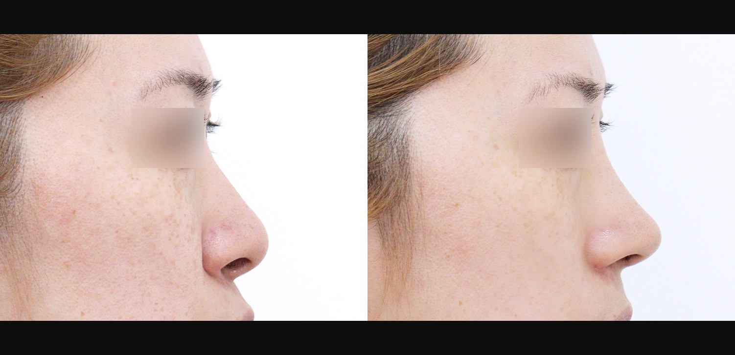 3D코성형(자가늑+용코+인중코+콧볼축소+기능코)