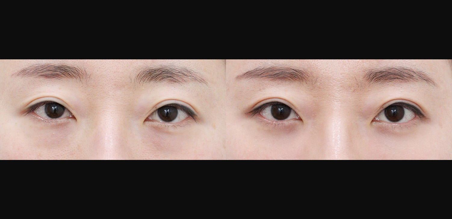 눈밑지방재배치