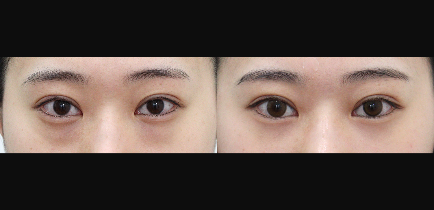 눈밑지방재배치+지방이식(앞광대)