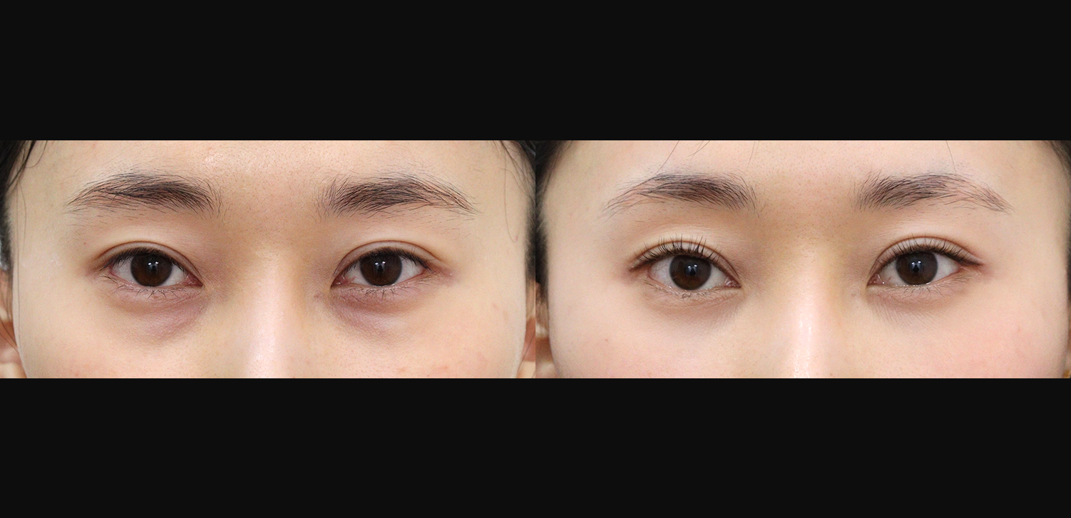 눈밑지방재배치+지방이식(앞광대)