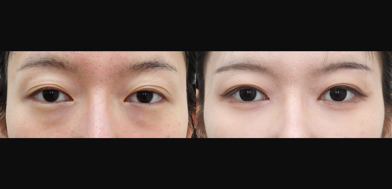 눈밑지방재배치+지방이식(앞광대)