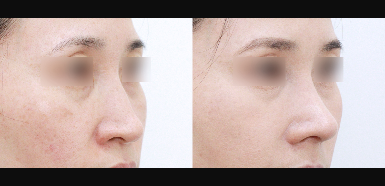 코끝+매부리+인중코+콧볼축소+기능코