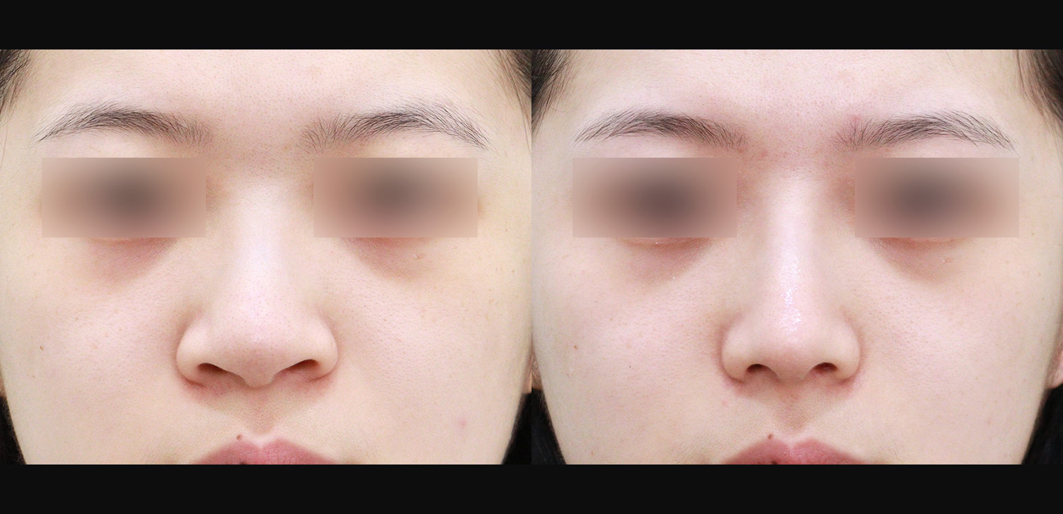 3D 코성형(자가늑+복코+콧볼축소+비주처짐+인중코, 기능코)