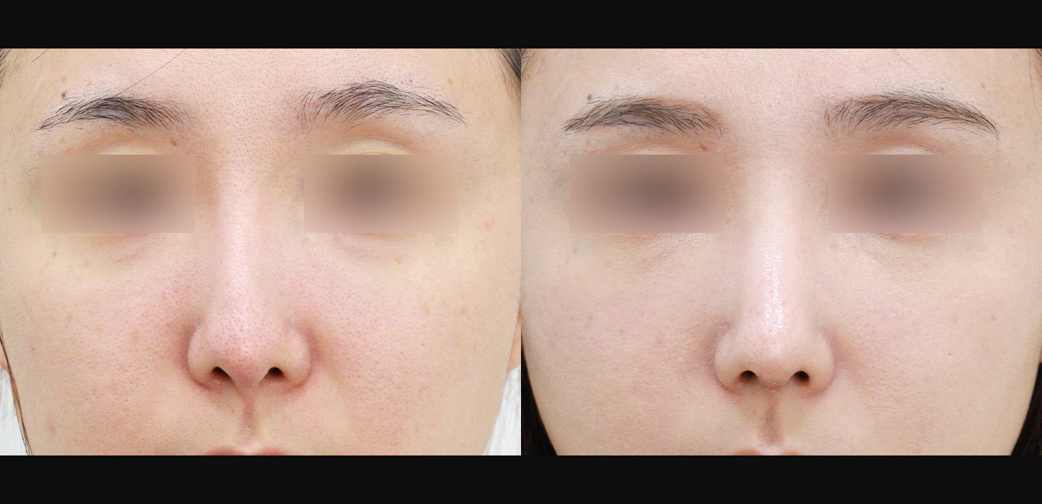 3D코성형 재수술(화살코+휜코+기능코)