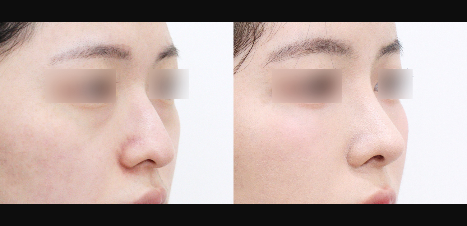 3D코성형(화살코+복코+인중코+기능코)