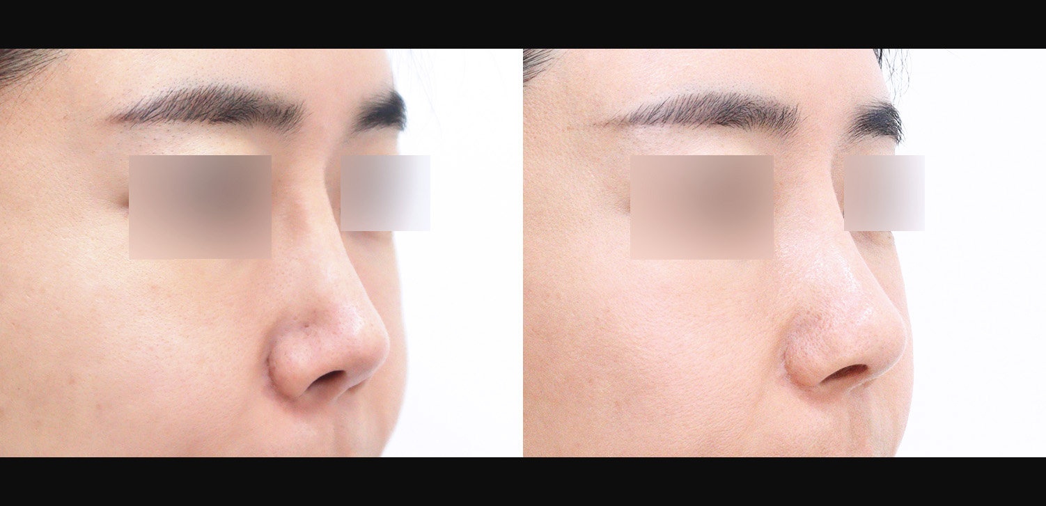 3D코성형 재수술(자가늑+콧대+코끝+복코+들창코+찝힌코+인중코+기능코)