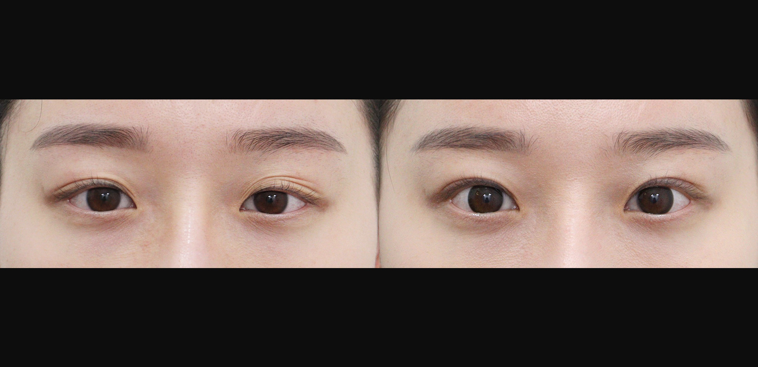 절개 쌍꺼풀+눈매교정