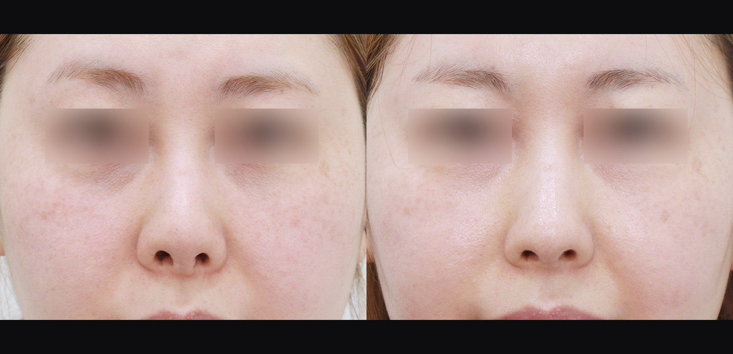 3D코성형 재수술(콧대+코끝+비중격재건+비주처짐개선)