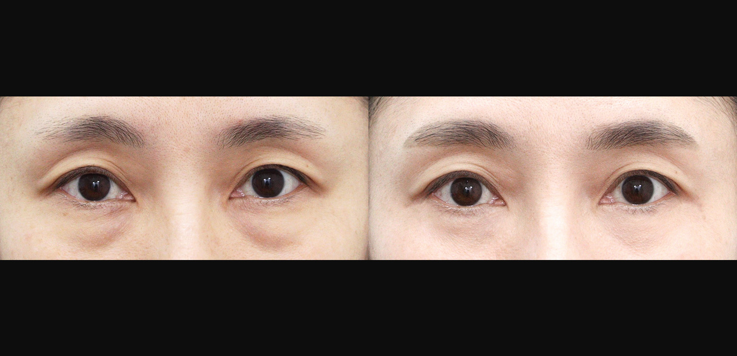 하안검+외안각고정술