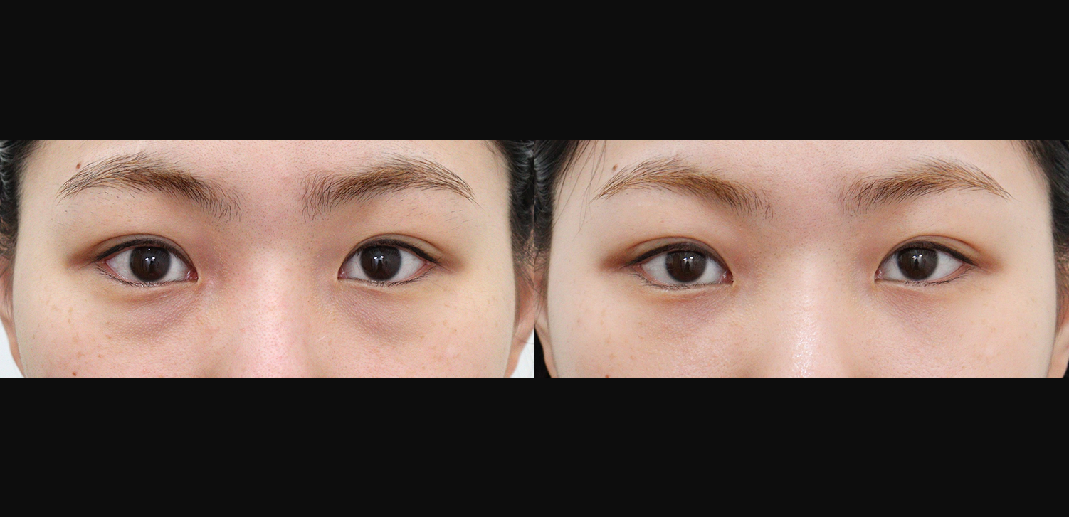 눈밑지방재배치+지방이식(앞광대)