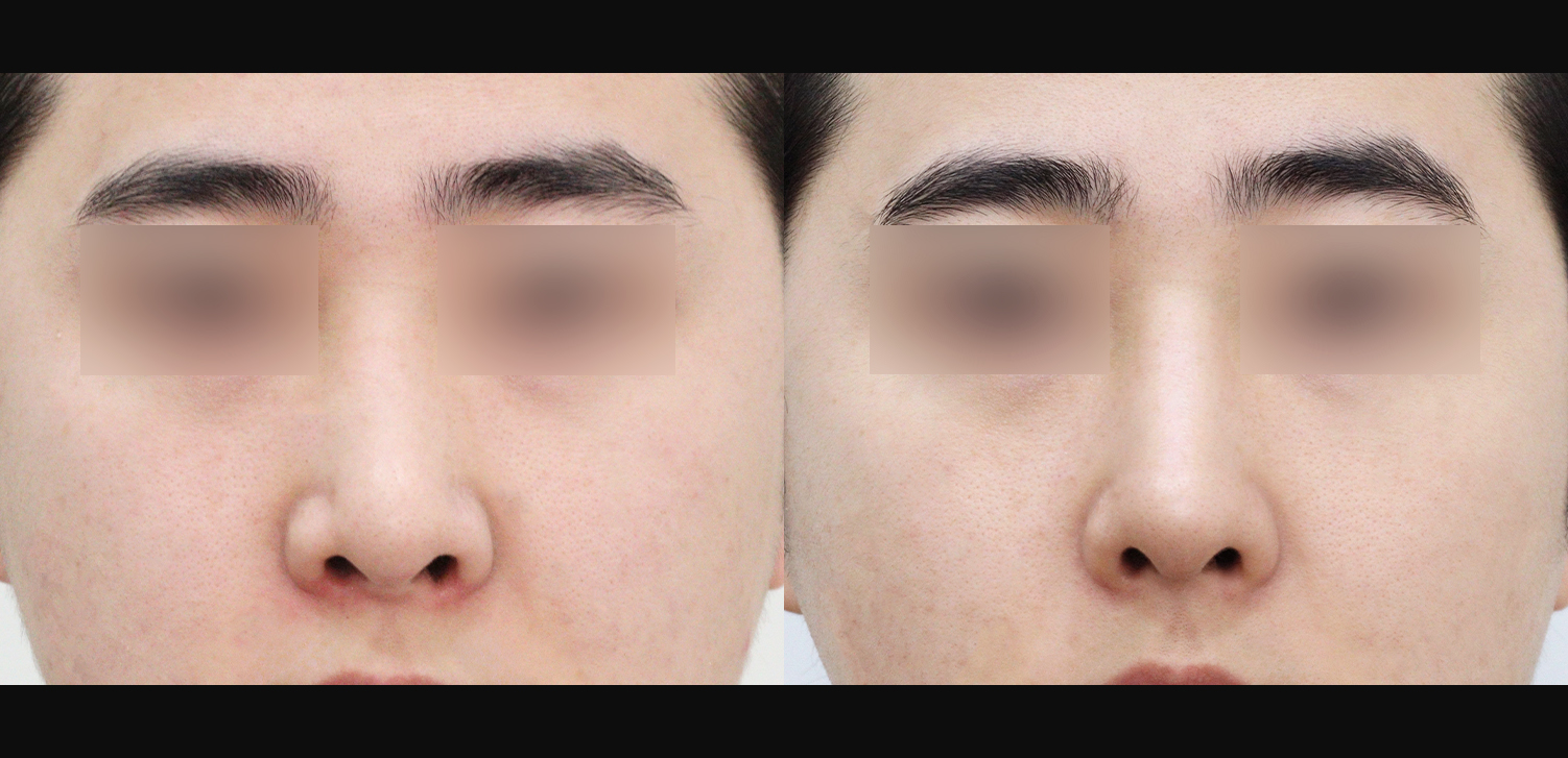 코재수술(늑연골+들창코+휜코+비중격재건+기능코)