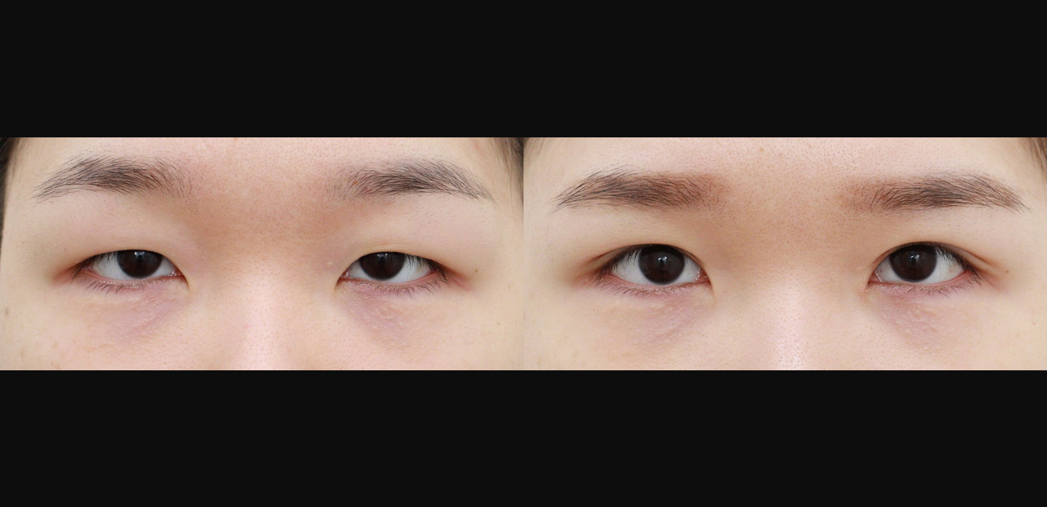 절개 쌍꺼풀+눈매교정+트임