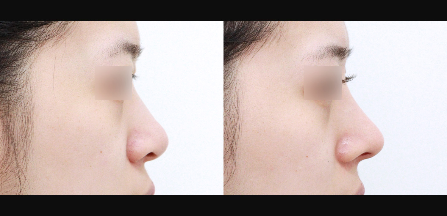 3D 코성형(자가늑+복코+콧볼축소+비주처짐+인중코, 기능코)