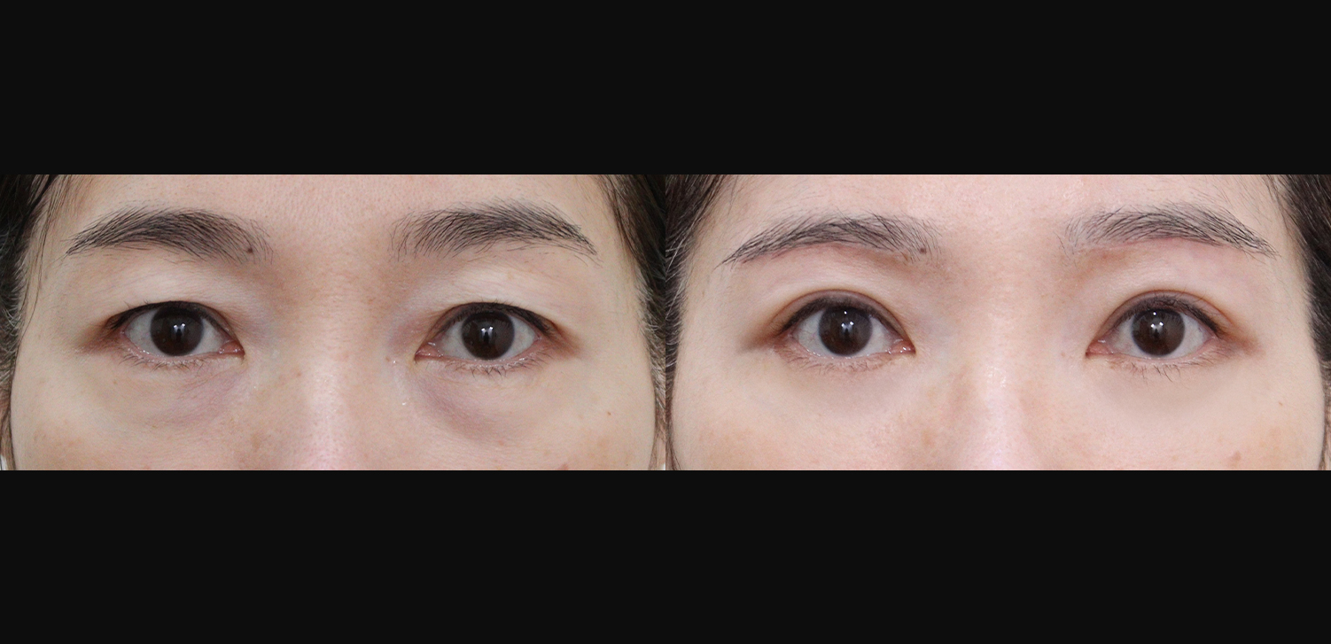 눈썹하거상+하안검+외안각고정