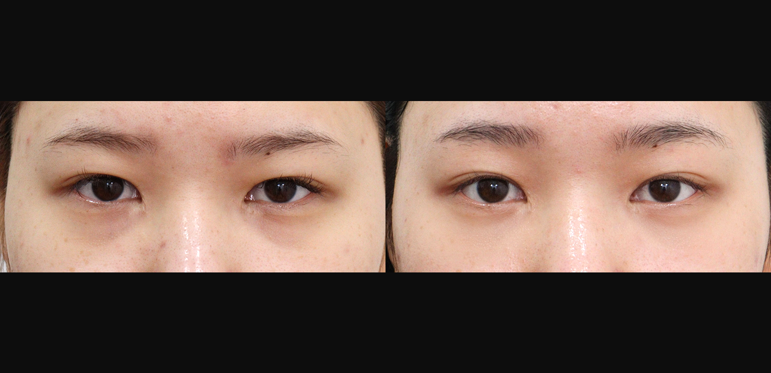 눈밑지방재배치+이마거상