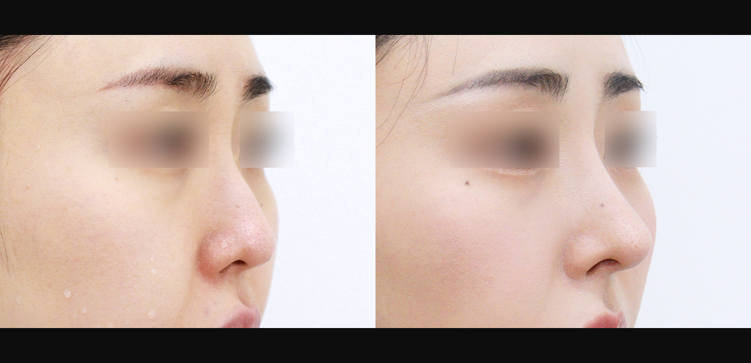 3D 코성형(콧대+코끝+인중코)