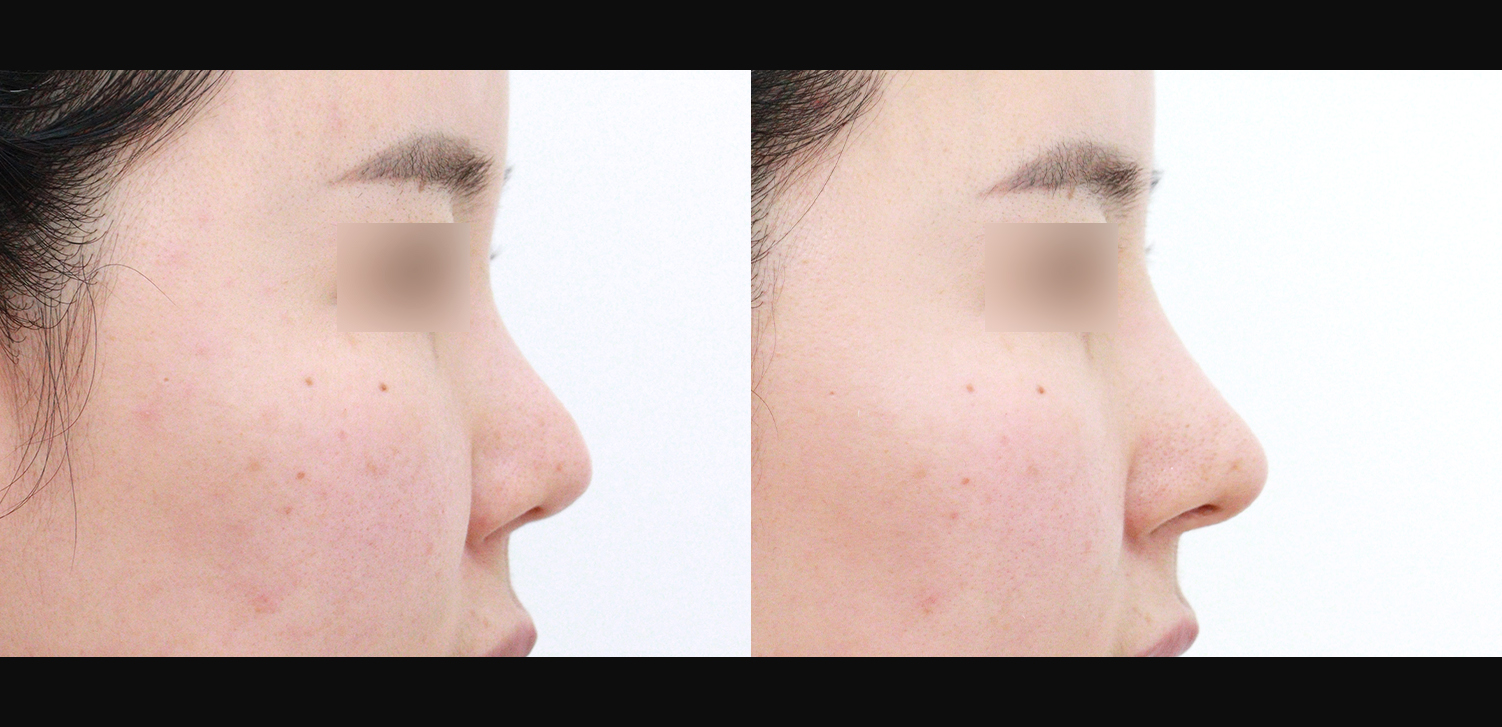 3D코성형 재수술(들창코+찝힌코+인중코)