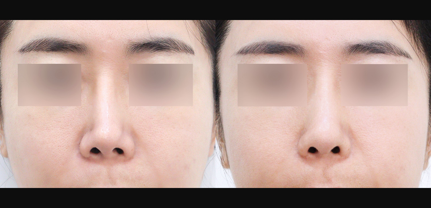 3D코성형 재수술(자가늑+콧대+코끝+복코+들창코+찝힌코+인중코+기능코)