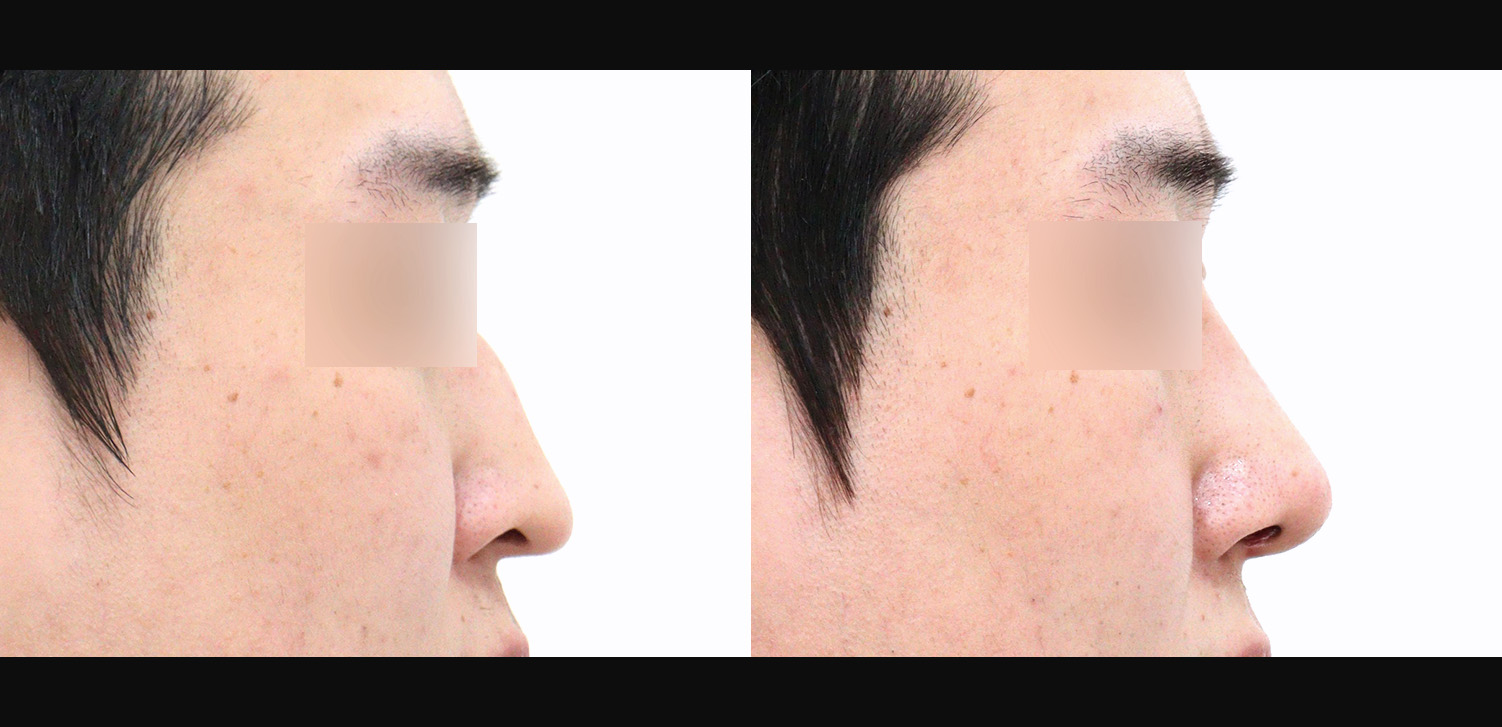 3D코성형(자가늑+콧대+코끝+매부리+화살코+용코+인중코+기능코)