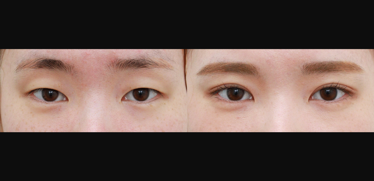 자연유착+눈매교정