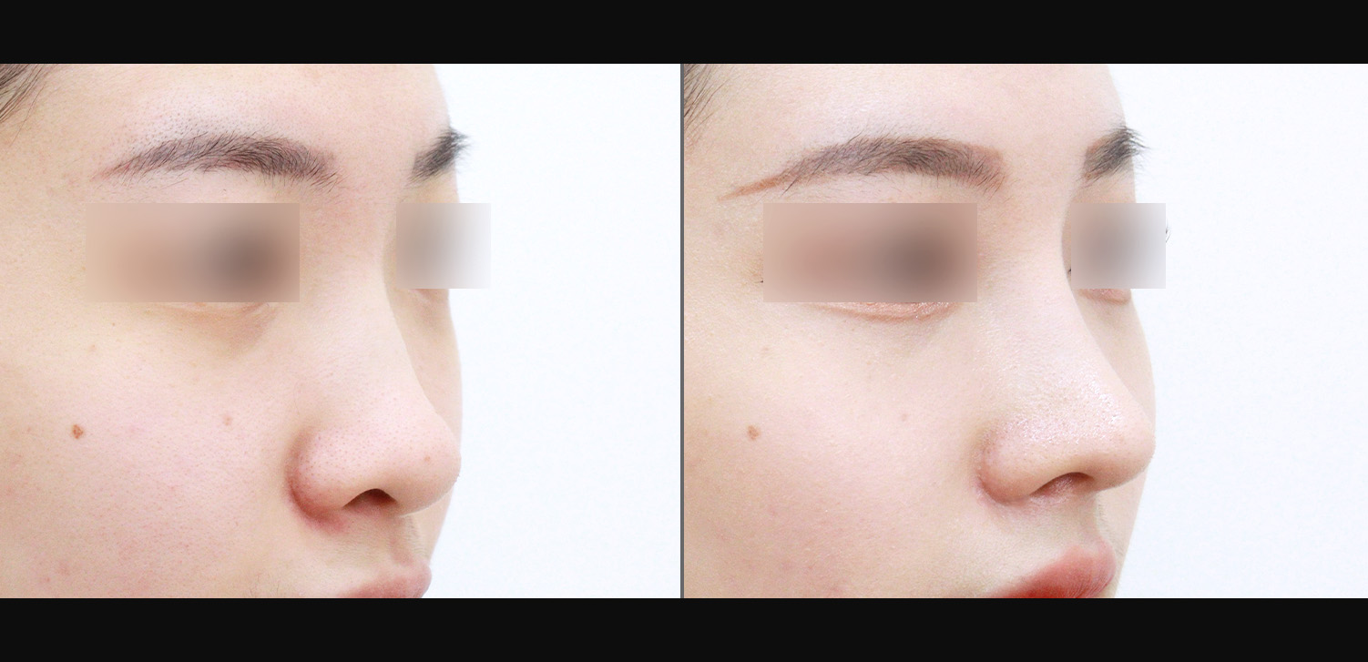 3D코성형 재수술(휜코+복코+기능코)