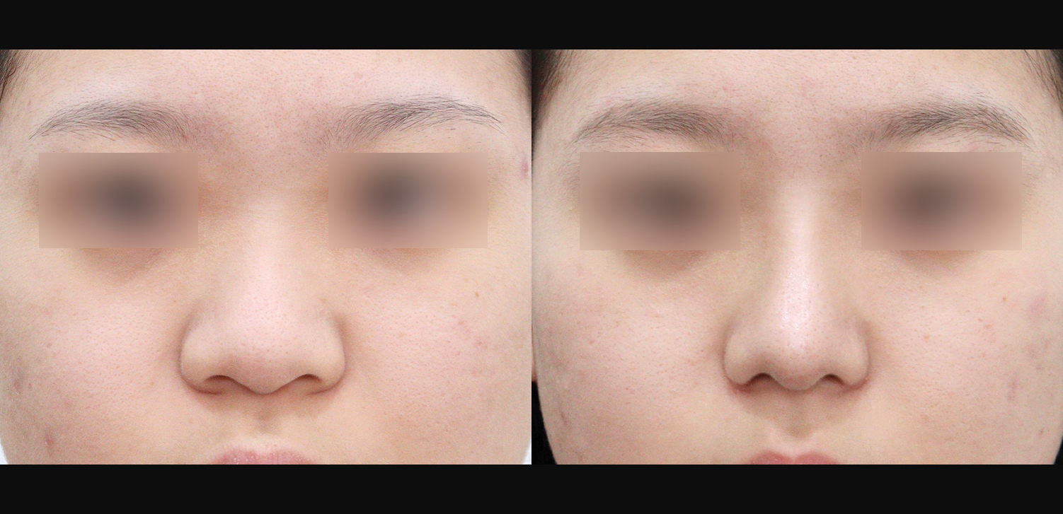 3D코성형(자늑+복코+인중코+콧볼축소)