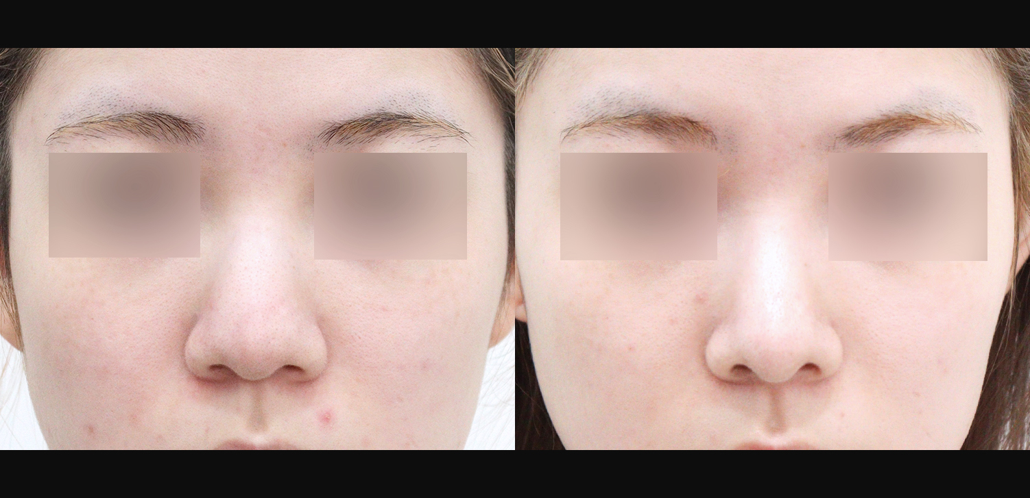 코끝+복코+인중+매부리+기능코