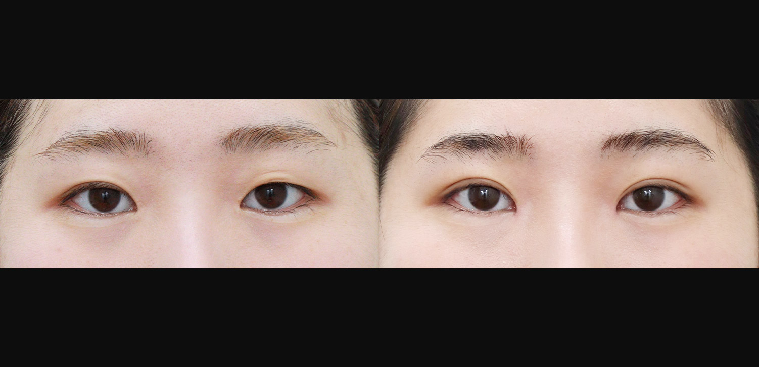 자연유착+트임