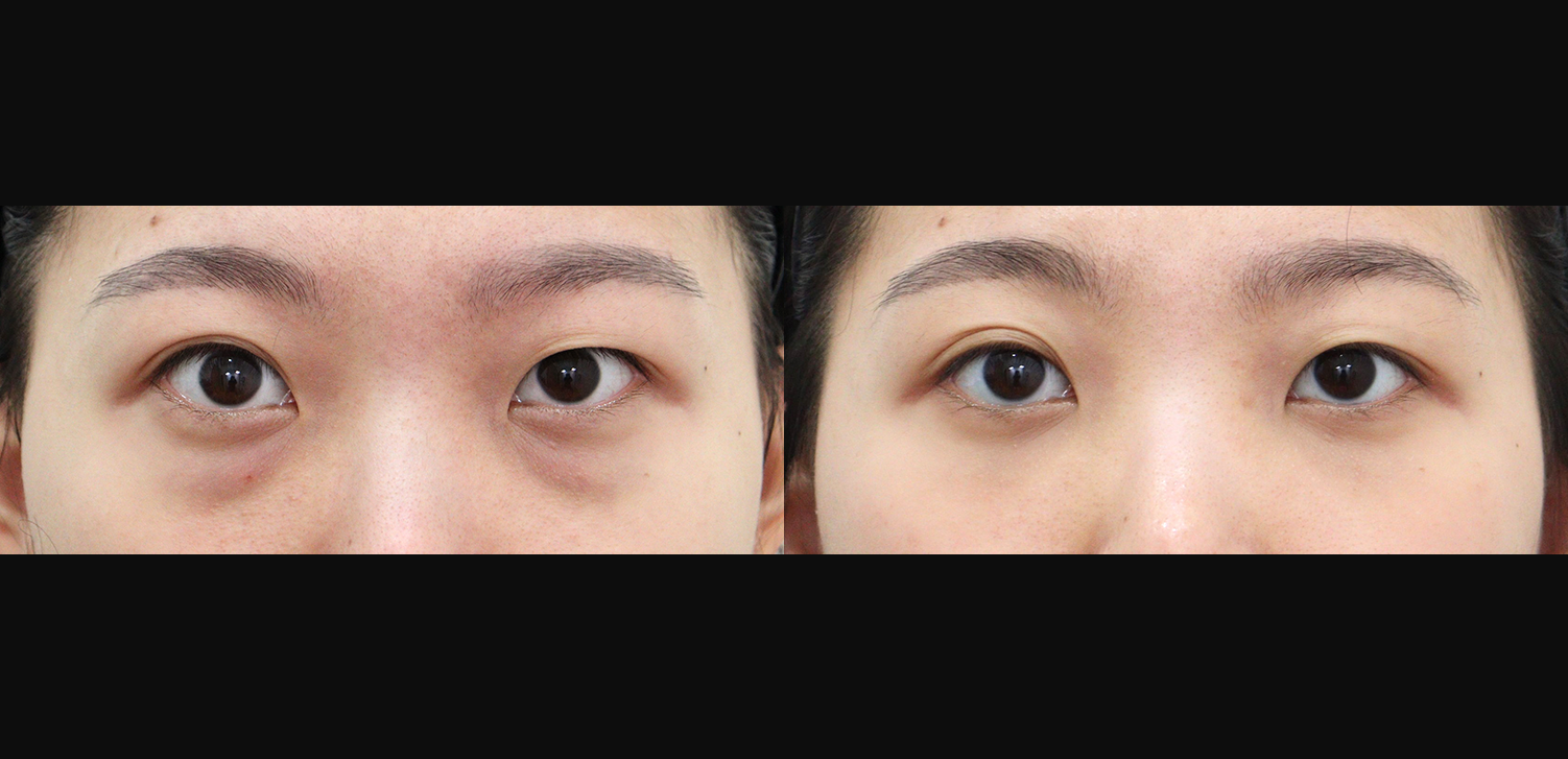 눈밑지방재배치