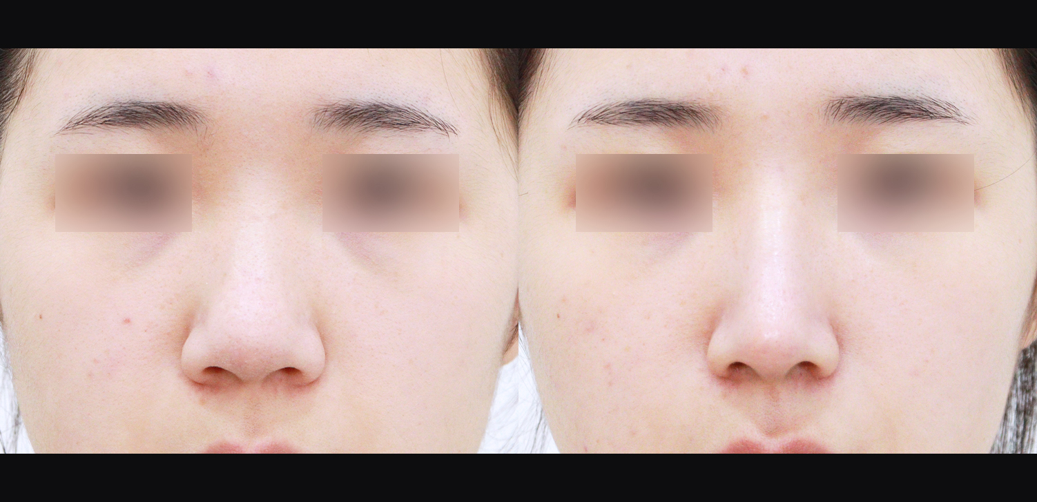 3D 코성형(복코+인중코+콧볼축소)