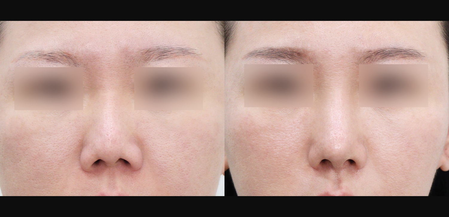 3D 코성형 재수술(자가늑+찝힌코+휜코+구축코+인중+기능코+비주빼기)