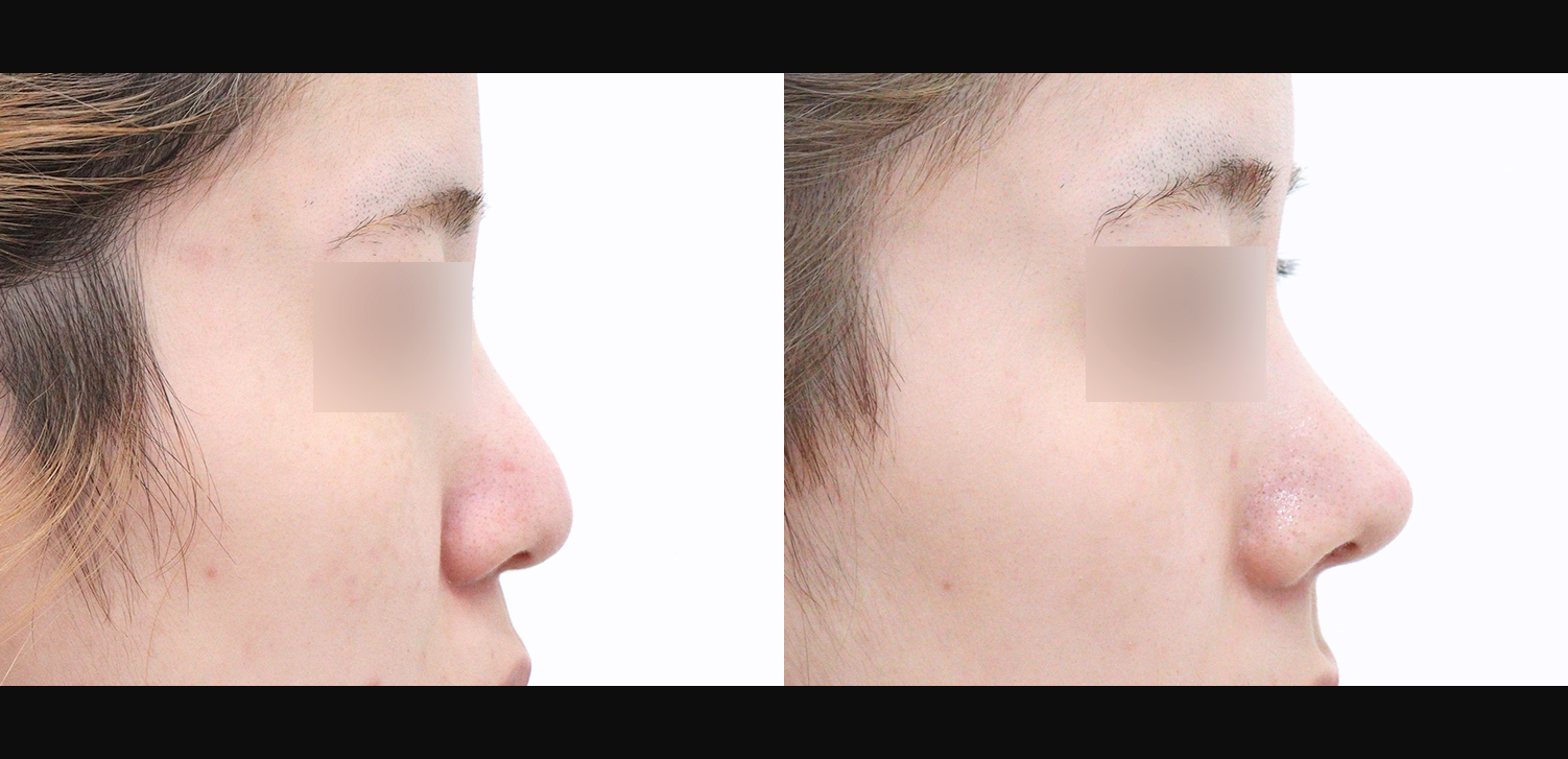 코끝+복코+인중+매부리+기능코