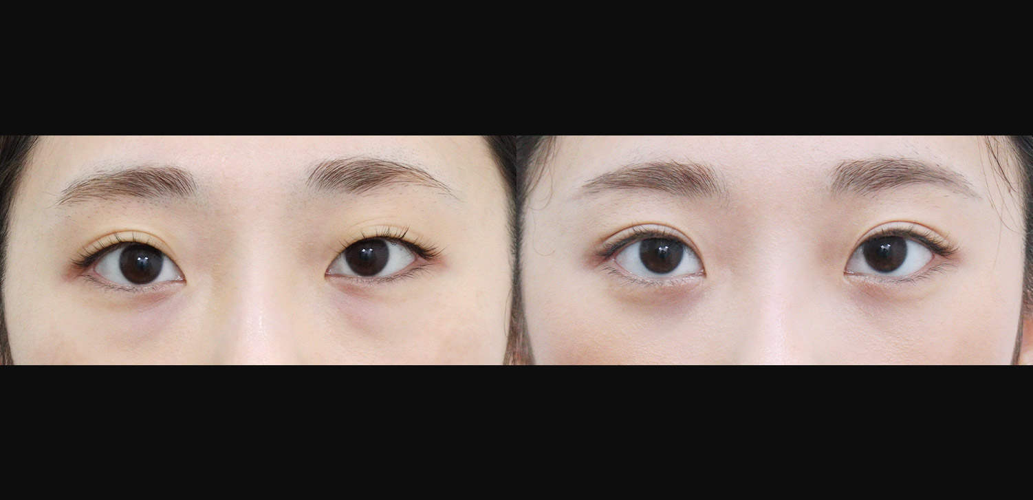 눈밑지방재배치+자연유착