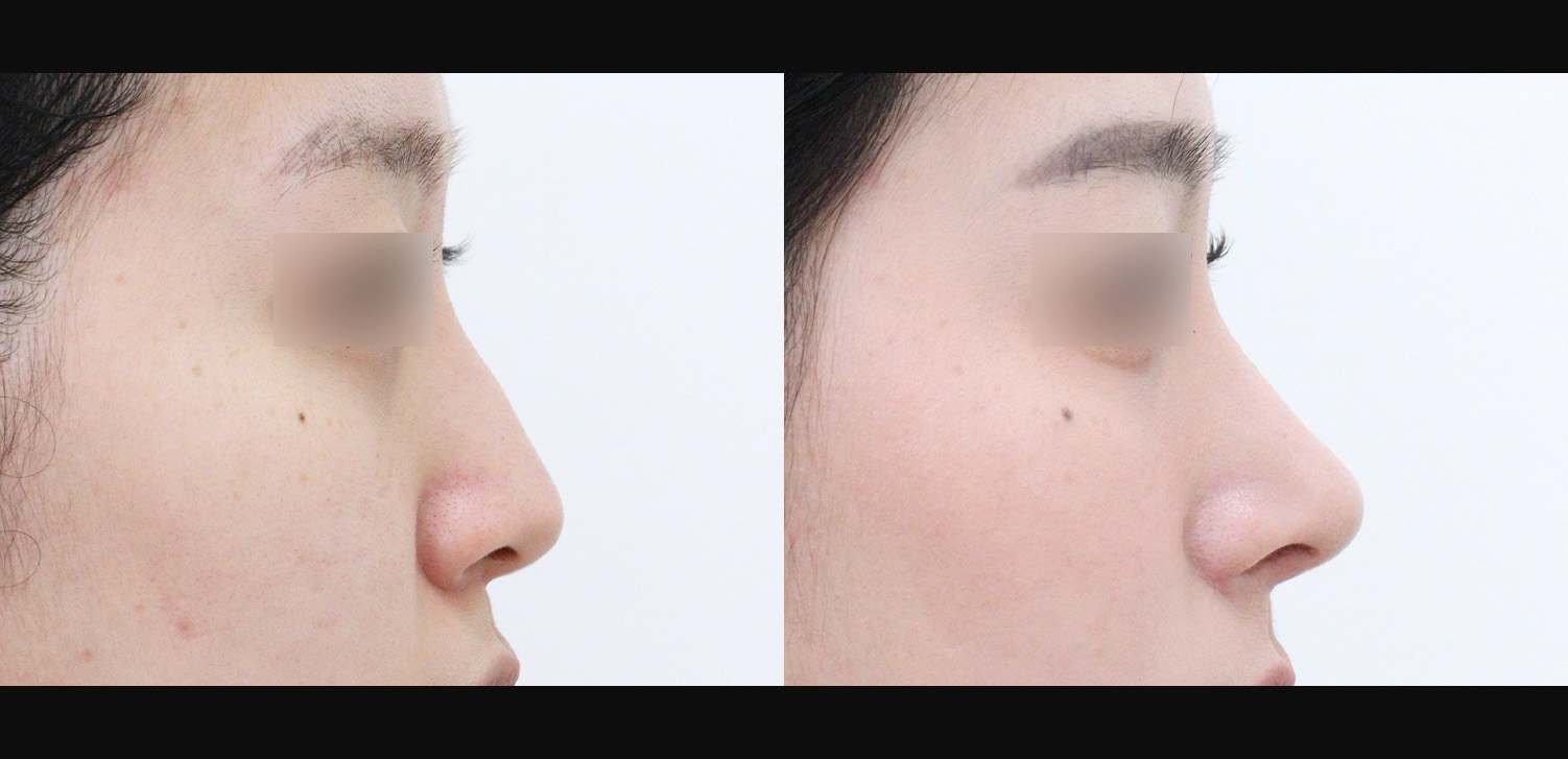 화살코+용코+휜코+인중코+콧볼축소+기능코