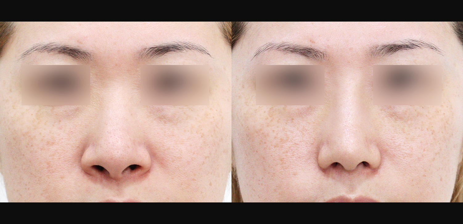 3D코성형(자가늑+용코+인중코+콧볼축소+기능코)